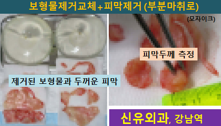 〔신유외과〕 구형구축생긴 보형물 제거,교체하고 피막제거 (부분마취로)