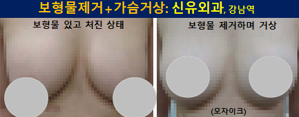 〔신유외과〕 식염수보형물 제거하면서 처진가슴거상(부분마취, 반달절개)