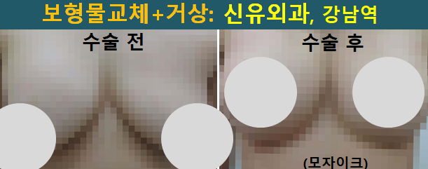 〔신유외과〕 파손된 보형물 제거교체하며 처진가슴거상 (부분마취, 반달절개로)