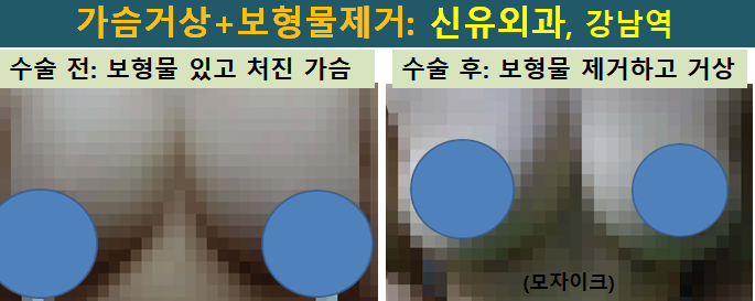 〔신유외과〕 처진가슴거상+보형물제거: 부분마취, 반달절개로