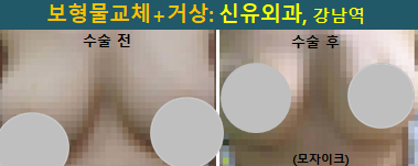 〔신유외과〕 파손된 보형물 제거교체(+피막제거)하고 처진가슴거상 (부분마취, 반달절개)