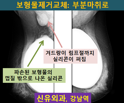 〔신유외과〕 피막외파손으로 실리콘이 겨드랑이림프절에 먹힌 보형물의 제거 교체+ 피막제거, 밑선교정도 같이: 부분마취로