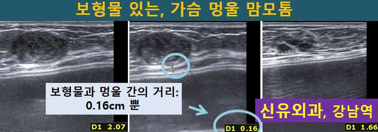 〔신유외과〕 보형물 있는, 고난도 맘모톰 (가슴멍울제거), 함몰유두교정도 같이.