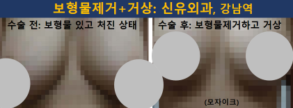 〔신유외과〕 파손된 보형물과 두꺼운 피막 제거하면서 처진가슴거상(중심확대방식): 부분마취, 반달절개로
