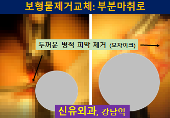 〔신유외과〕 구형구축 생기고 많이 접힌 텍스쳐보형물 제거교체+ 피막제거와 방트기도 같이 (부분마취로)