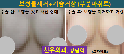 〔신유외과〕 가슴거상+보형물제거+피막제거(양쪽 파손: 피막외파손으로 겨드랑이림프절에 실리콘 먹힌 상태)