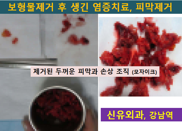 〔신유외과〕 보형물제거 6개월 뒤, 급성염증치료하고 잔존실리콘과 손상피막제거