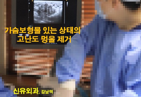 <신유외과> 보형물에 인접한 거대유방멍울의 제거