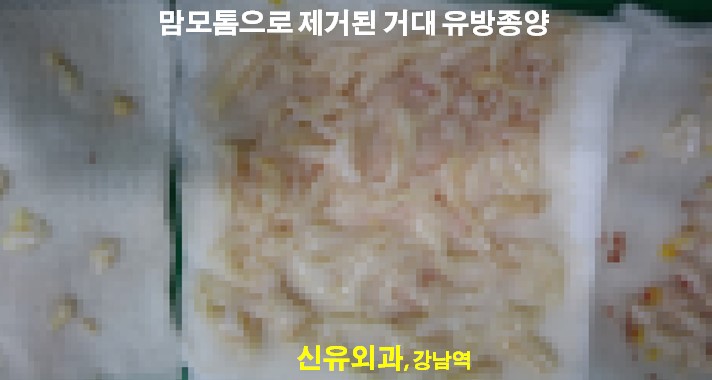 <신유외과> 커다란 유방멍울 제거 (고난도 맘모톰)