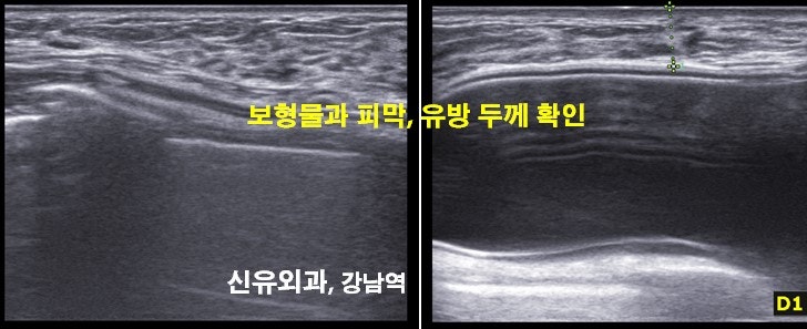 <신유외과> 파손보형물 제거교체, 혈종과 피막 제거, 방트기 (부분마취)