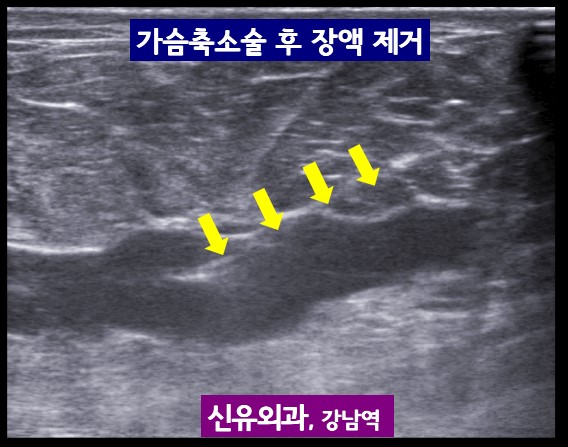 <신유외과> 유방축소술 후에 초음파검사가 중요한 이유