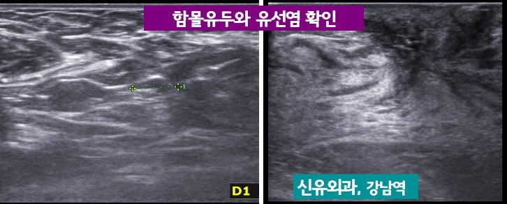 <신유외과> 함몰유두 교정이 반드시 필요한 이유 (유선염이 생긴 함몰유두 교정의 예)