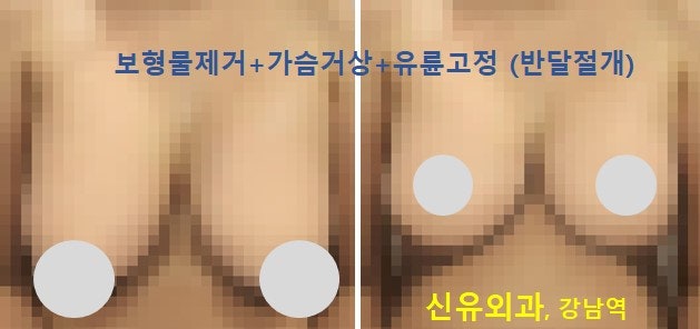 <신유외과> 파손된 보형물 제거+ 가슴거상+ 유륜고정 (반달절개)