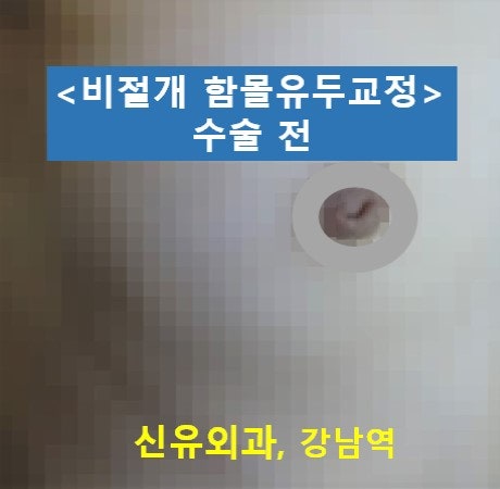 <신유외과> 함몰유두교정 (비절개, 비봉합: 재내원이 필요없는)