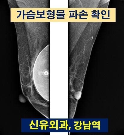 <신유외과> 파손 보형물 제거/교체, 피막 제거, 방 교정 (부분마취로)