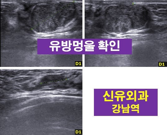 <신유외과> 큰 유방멍울 제거 맘모톰