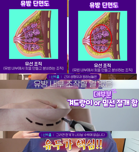<신유외과> 짝가슴 어떻게 해결하나요 크기,위치 교정 방법! (2)