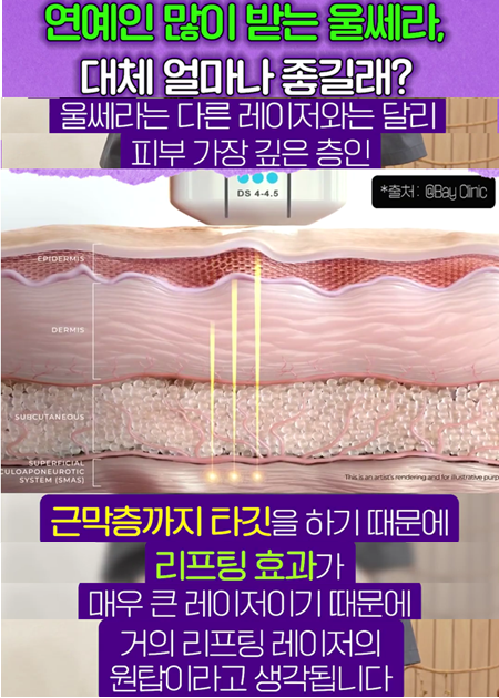 <신유피부클리닉> 여배우 리프팅 울쎄라 얼마나 좋은지 감도 안옴;;