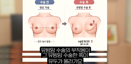 <신유외과> 가슴축소수술 후 후회하는 분들의 공통점이 있습니다.