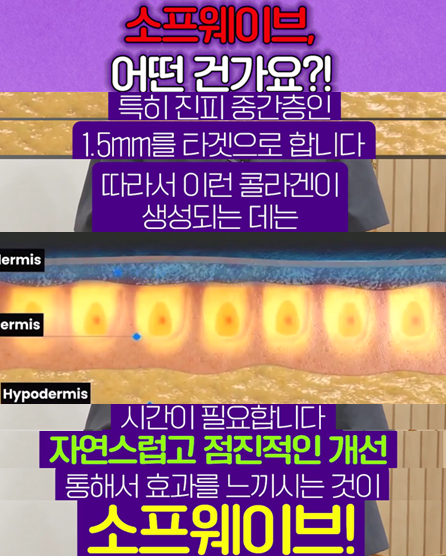 소프웨이브 효과 볼 수 있는 나이가 있다?