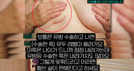 짝가슴 교정이 정말 필요한 사람들/유방암 재건 , 폴란드 증후군, 심한 비대칭... 사진 2