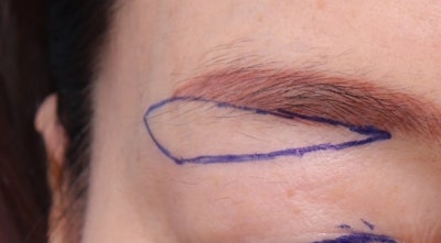 What kind of person is a good candidate for a sub-brow lift? Cases with good results, before and after photos, and its history, concept, and techniques.