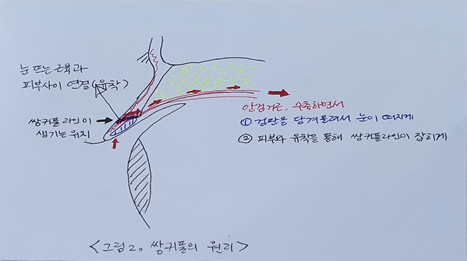 심정환 원장님이 알려주는 소시지 눈 재수술!