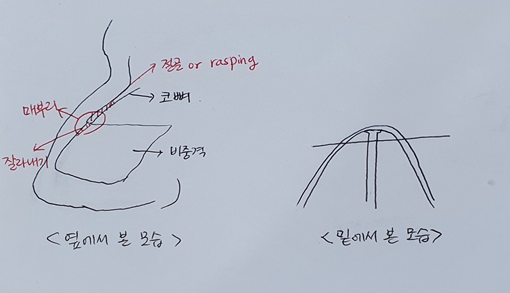매부리코는 절골이 필수일까요?