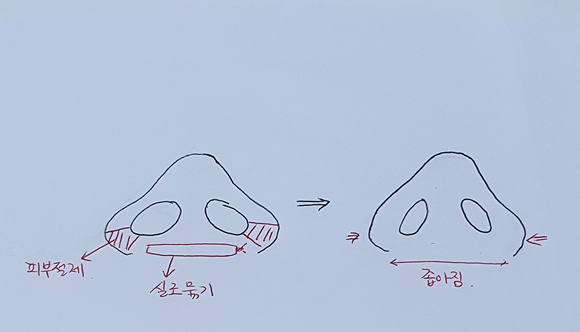 콧볼축소만으로 코가 높아보이는 효과가 있을까요?