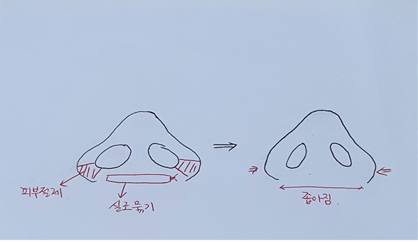 小鼻縮小だけでも鼻が高く見えるのでしょうか？