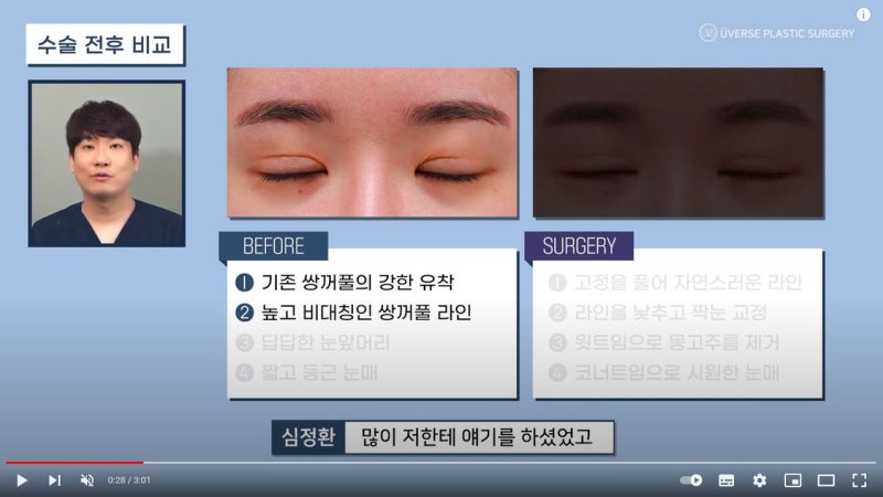 [عيادة ويفرس للجراحة التجميلية] الجفن المزدوج المنتفخ~ الحصول على عيون واسعة ومشرقة من خلال الجراحة التصحيحية، الندبات العميقة/ الطية المنغولية/ توسيع زاوية العين العلوية/ توسيع زاوية العين الجانبية