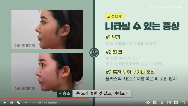 [Weverse Plastic Surgery] สัมภาษณ์หลังแก้จมูกครบ 3 ปี! อาการบวม/จมูกเบี้ยว หลังศัลยกรรมจมูก และอื่นๆ
