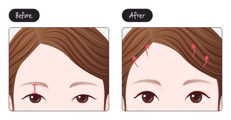 กรณีที่เปลือกตาตกทับดวงตา สามารถแก้ไขด้วยการดึงหน้าผากได้หรือไม่?