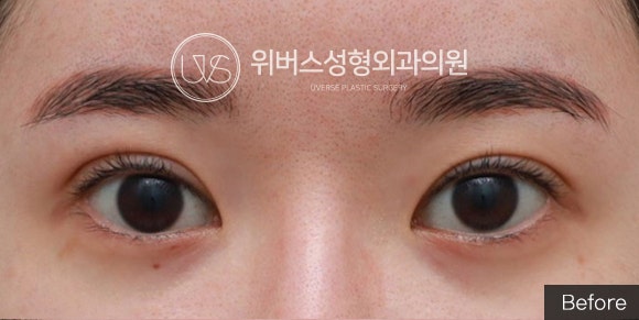 ปรับลดระดับชั้นตาหอยแครง (Sausage Eyelid) & Corner Canthoplasty