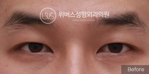 [Kasus Nyata] Operasi Mata Pria (Lipatan Mata Insisi, Lower Canthoplasty)