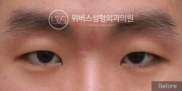 [Kasus Nyata] Operasi Mata Pria (Kelopak Mata Tebal, Lipatan Mata Insisi, Koreksi Ptosis, Epikantoplasti)