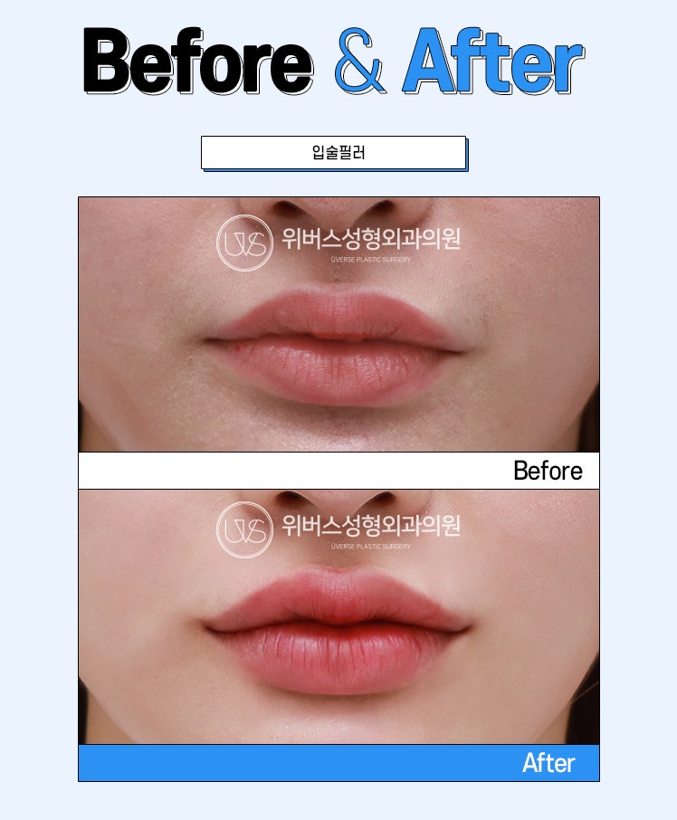 Apakah Ada Area yang Tidak Boleh Disuntik Filler? Pipi Depan? Garis Senyum? Glabella?