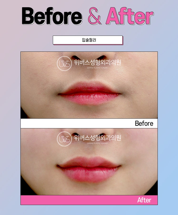 Apakah Filler Benar-benar Bisa Larut 100%?