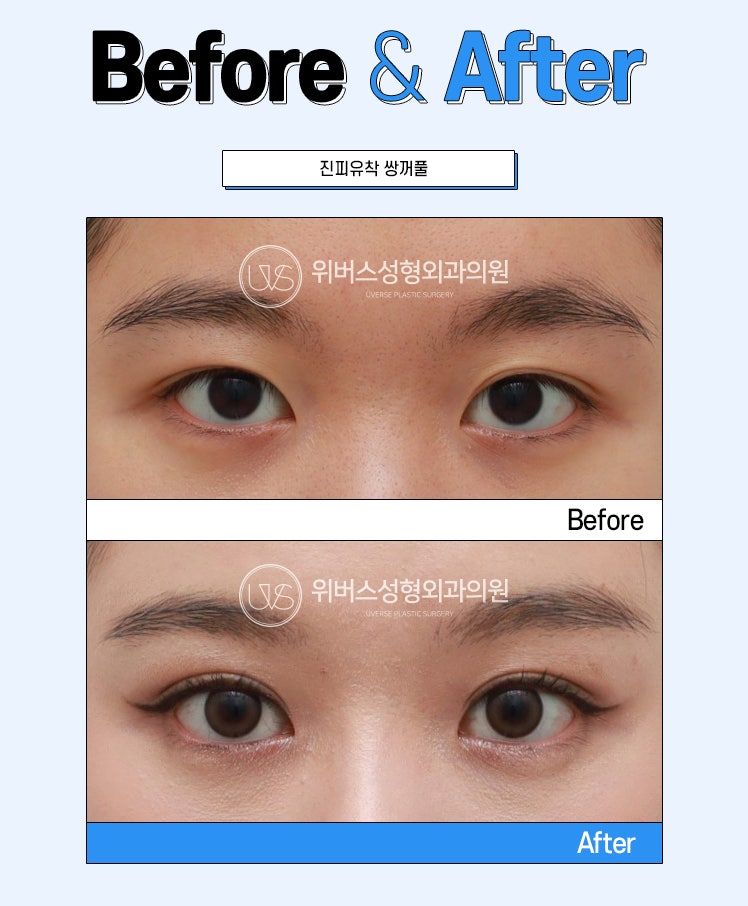 Jika Menggunakan Lem dan Selotip Kelopak Mata Ganda dalam Waktu Lama, Apakah Operasi dengan Adhesi Natural Menjadi Tidak Mungkin?