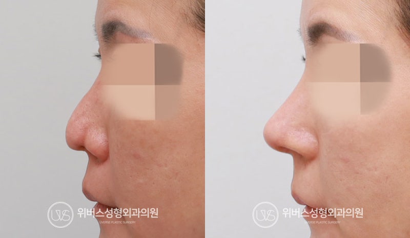 [حالة مريض حقيقية] عملية إعادة تجميل الأنف بغضروف الضلع الذاتي، الأنف المنحرف، تصحيح عمود الأنف