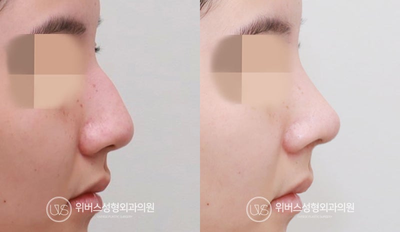 [حالة حقيقية] عملية تجميل الأنف بدون حشوات