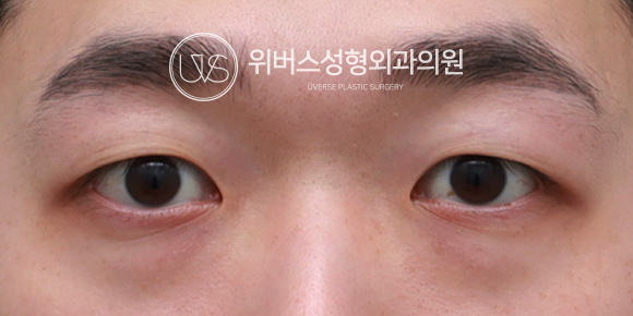 [실환 케이스 리뷰] 눈밑지방재배치