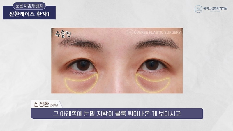 눈밑지방재배치 유형별케이스(+눈밑지방제거, 실제 환자 케이스)