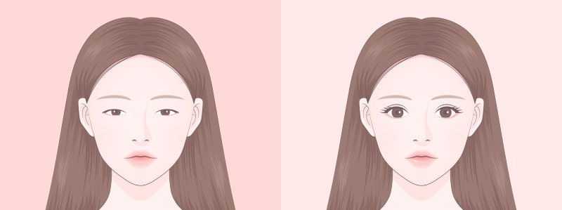 눈 뜨는 힘이 약한 경우 쌍꺼풀 수술만으로 부족한 이유 - 눈매교정 필요성
