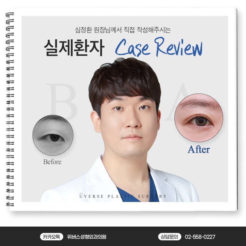 รีวิวเคส: ชั้นตาแบบตัดผ่า + แก้ไขสายตา + ตัดหนังตาชั้นใน + กำจัดไขมันเหนือตา