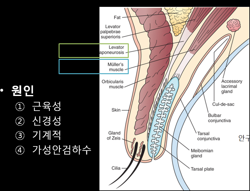 5. 눈매교정 수술 (안검하수 교정수술)