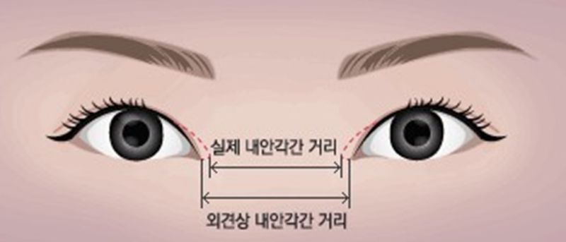 6. 开眼角手术