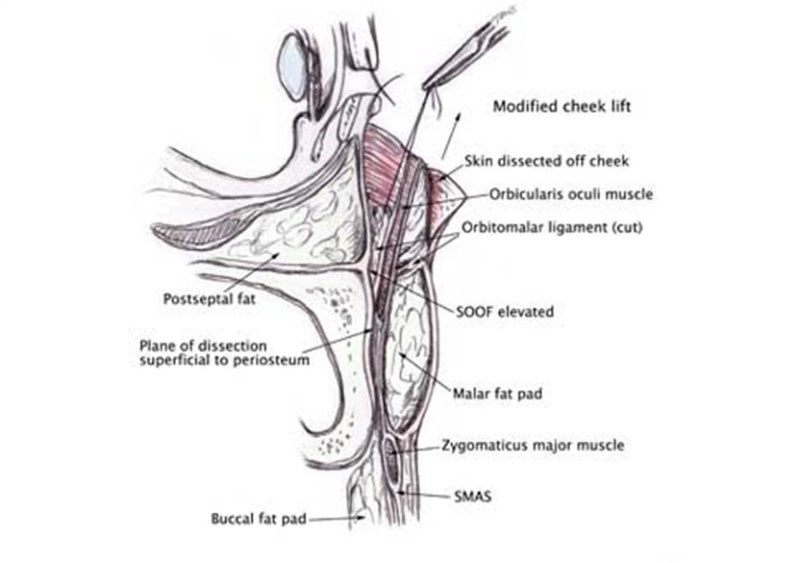 7. جراحة تجميل الجفن السفلي