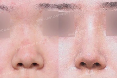 Rhinoplasty for a Low and Short Nose