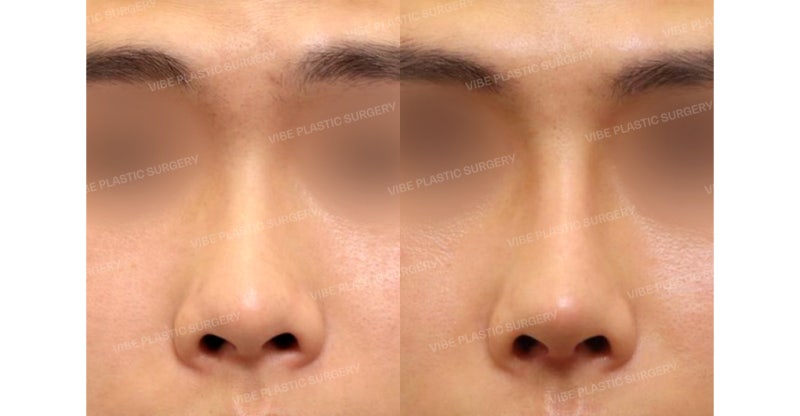 Phẫu thuật nâng mũi ngắn cho nam giới